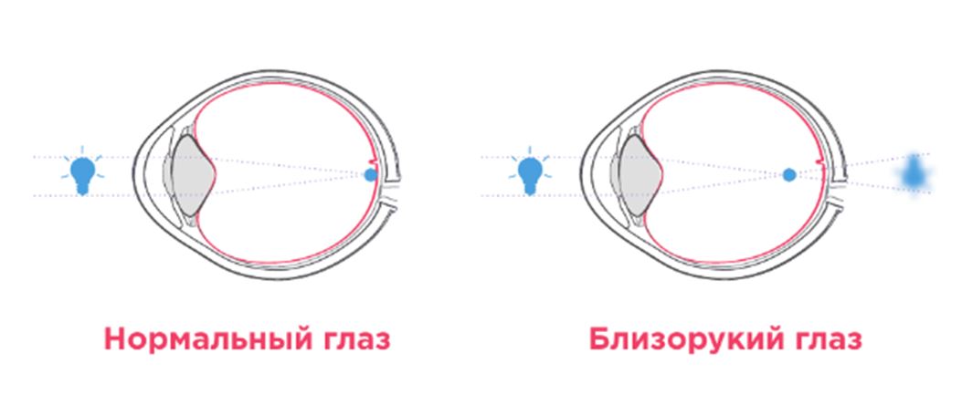 Что такое миопия?